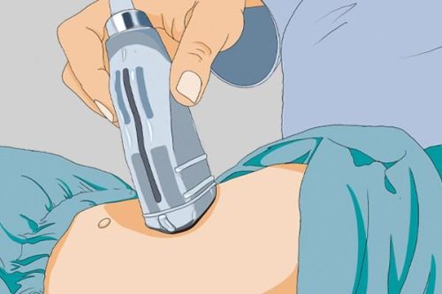 九价疫苗对女生要求年龄(九价疫苗)插图3