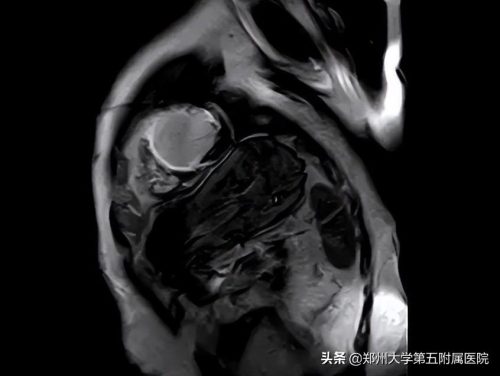 cmr垂直盘什么意思 (浅谈心脏磁共振)插图2
