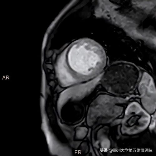 cmr垂直盘什么意思 (浅谈心脏磁共振)插图1