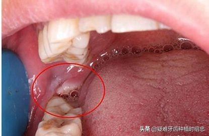 拔智齿后那个洞臭到恶心(拔智齿留了个洞很臭)插图1