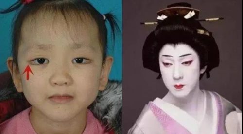 歌舞伎综合症是什么病(歌舞伎综合症宝宝照片)插图2