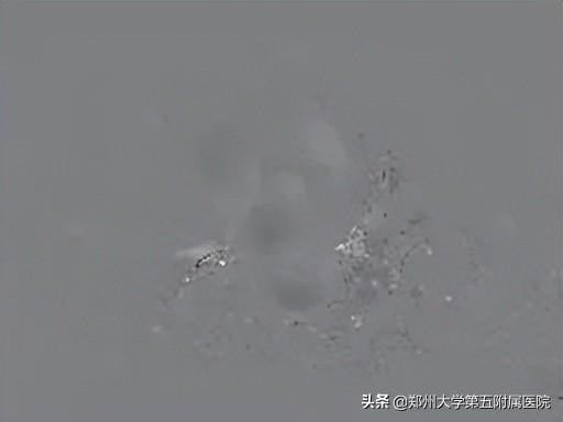 cmr垂直盘什么意思 (浅谈心脏磁共振)插图5