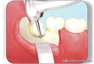 拔智齿后那个洞臭到恶心(拔智齿留了个洞很臭)插图3