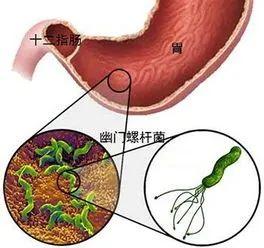碳14数值15严重么(幽门螺杆菌能自愈吗)插图3