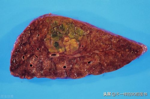 吴孟达肝癌作了手术为什么会死(吴孟达肝癌做的什么手术)插图1