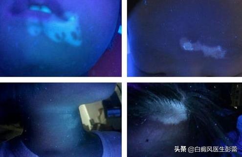 伍德灯颜色对照表(伍德灯颜色对照表图片)插图1