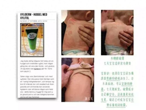 芬兰过敏药膏排名前十(染头过敏抹什么药膏)插图15