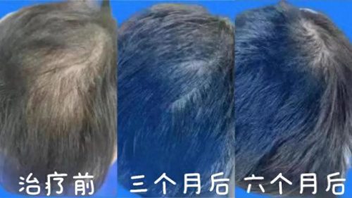 南昌脱发科室排名前十(南昌治脱发最好医院)插图7