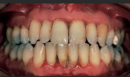 十大口腔疾病排行榜最新(口腔常见的十大疾病)插图5
