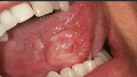 十大口腔疾病排行榜最新(口腔常见的十大疾病)插图9