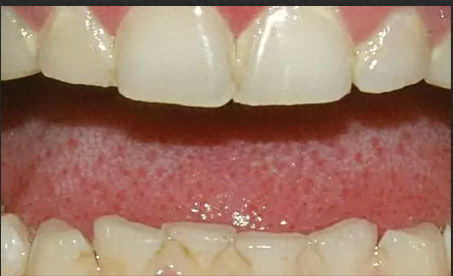 十大口腔疾病排行榜最新(口腔常见的十大疾病)插图3