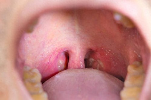 婴儿咽炎药十大排行榜(慢性咽炎用什么药好)插图5