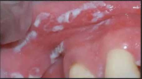 十大口腔疾病排行榜最新(口腔常见的十大疾病)插图6
