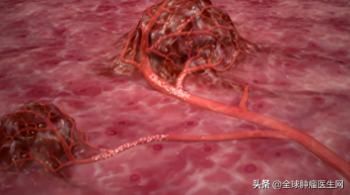 治疗肝部肿瘤排名前十(肝部巨大肿瘤能治好吗)插图