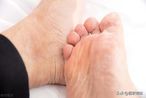 深圳脚气医生排名前十(选大夫抑菌乳膏可以治脚气吗)插图1